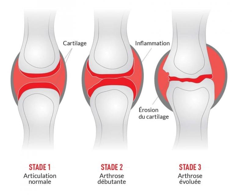 Arthrose et mobilité articulaire : qu'est-ce que l'arthrose ?