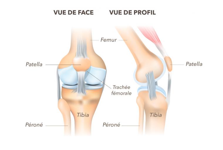 Gonarthrose : les 3 types d'arthrose du genou ?