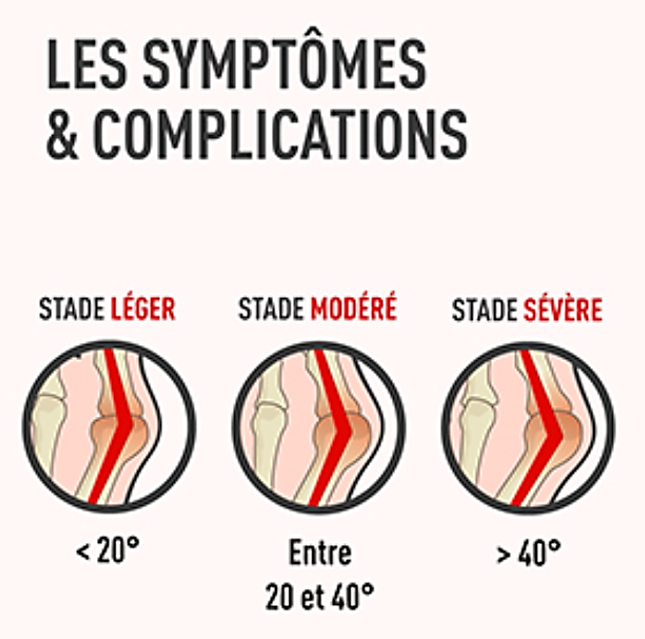 Hallux valgus ; étape