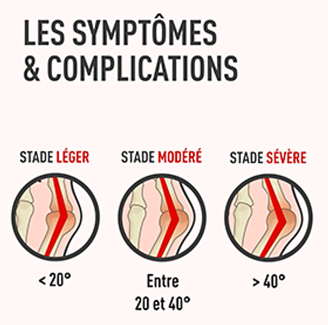 Hallux Valgus Pathologie Et Traitement GIBAUD Hallux Valgus Pathologie Et Traitement GIBAUD