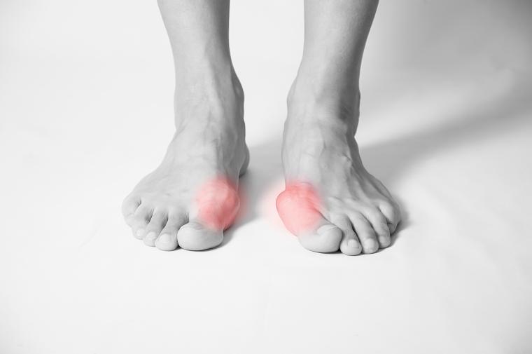 Hallux valgus : déviation gros orteil