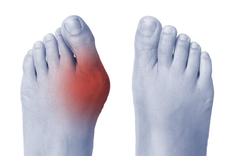 Hallux Valgus : comment traiter et soulager un Hallux Valgus ...